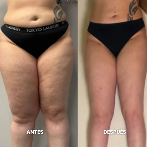 Antes y después del abdomen y las piernas tras ocho semanas