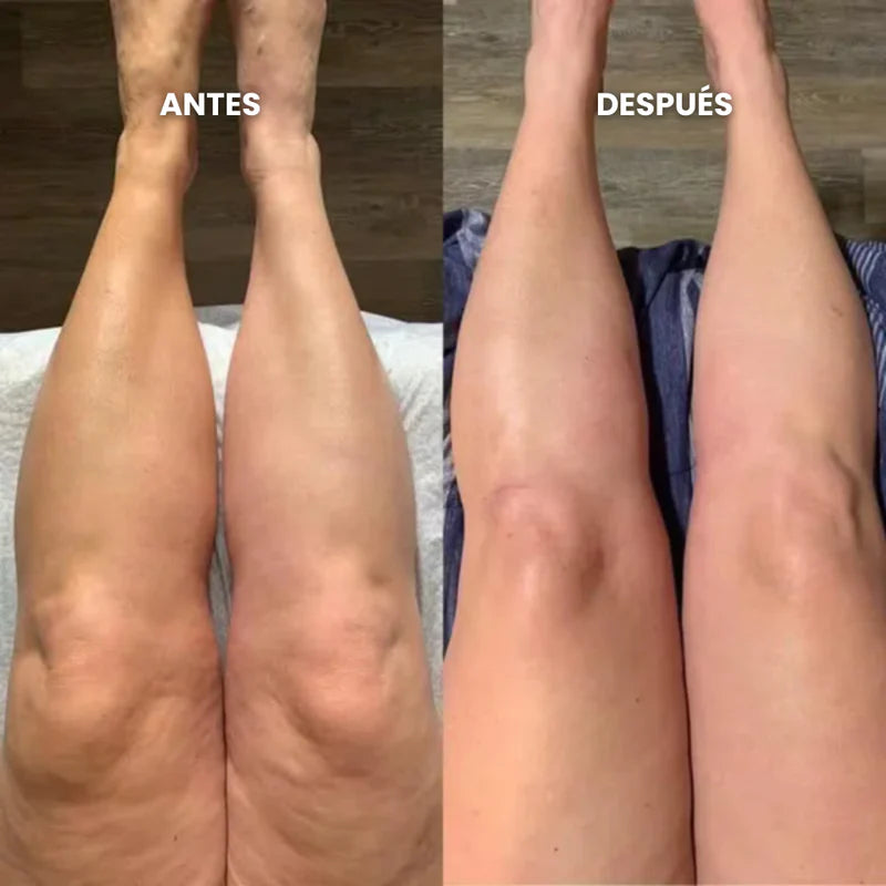 Antes y después de las pantorrillas en las primeras 24 horas