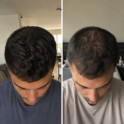 BODYWISE HAIR: Crecimiento Capilar Derma-Roller